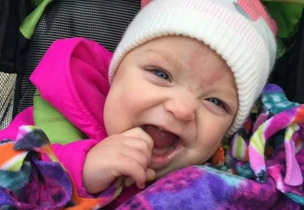 Paisley, now 16-months-old, had her second tongue reduction surgery six months ago. Source: Supplied.