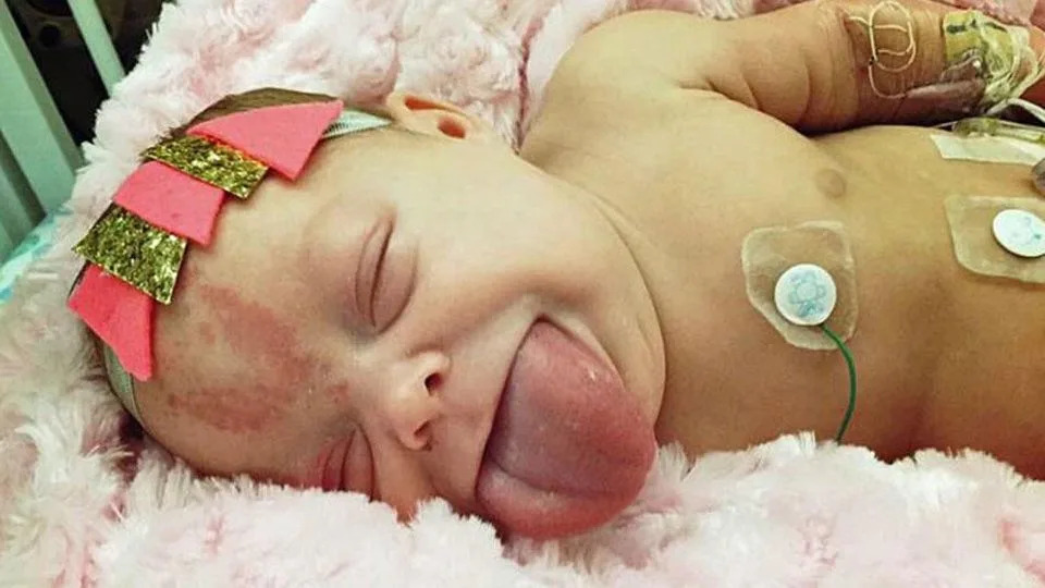Baby Paisley was born with the rare condition, Beckwith Wiedemann Syndrome.